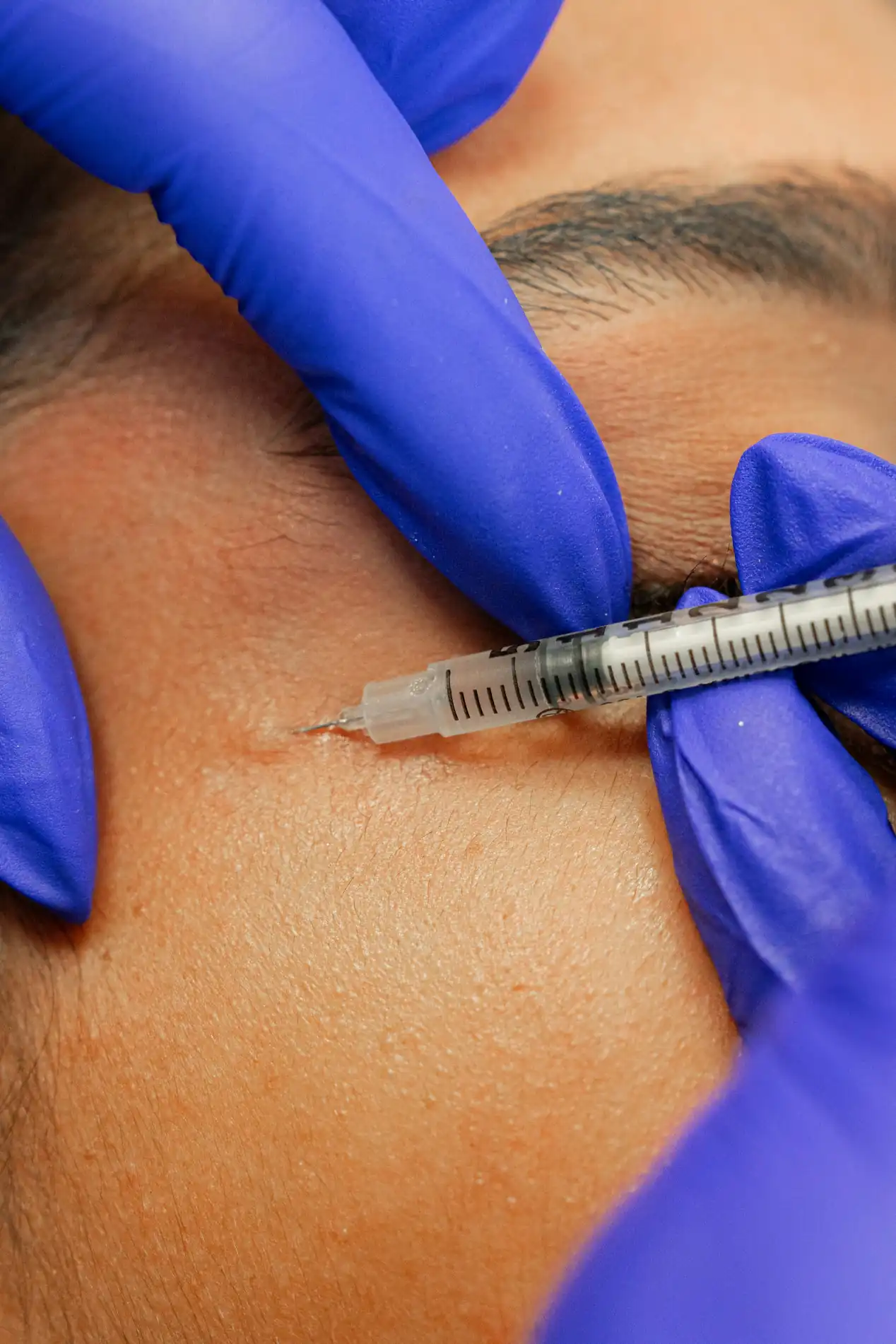 Botox-Behandlung Prof. Dr. Christian Weinand Hamburg