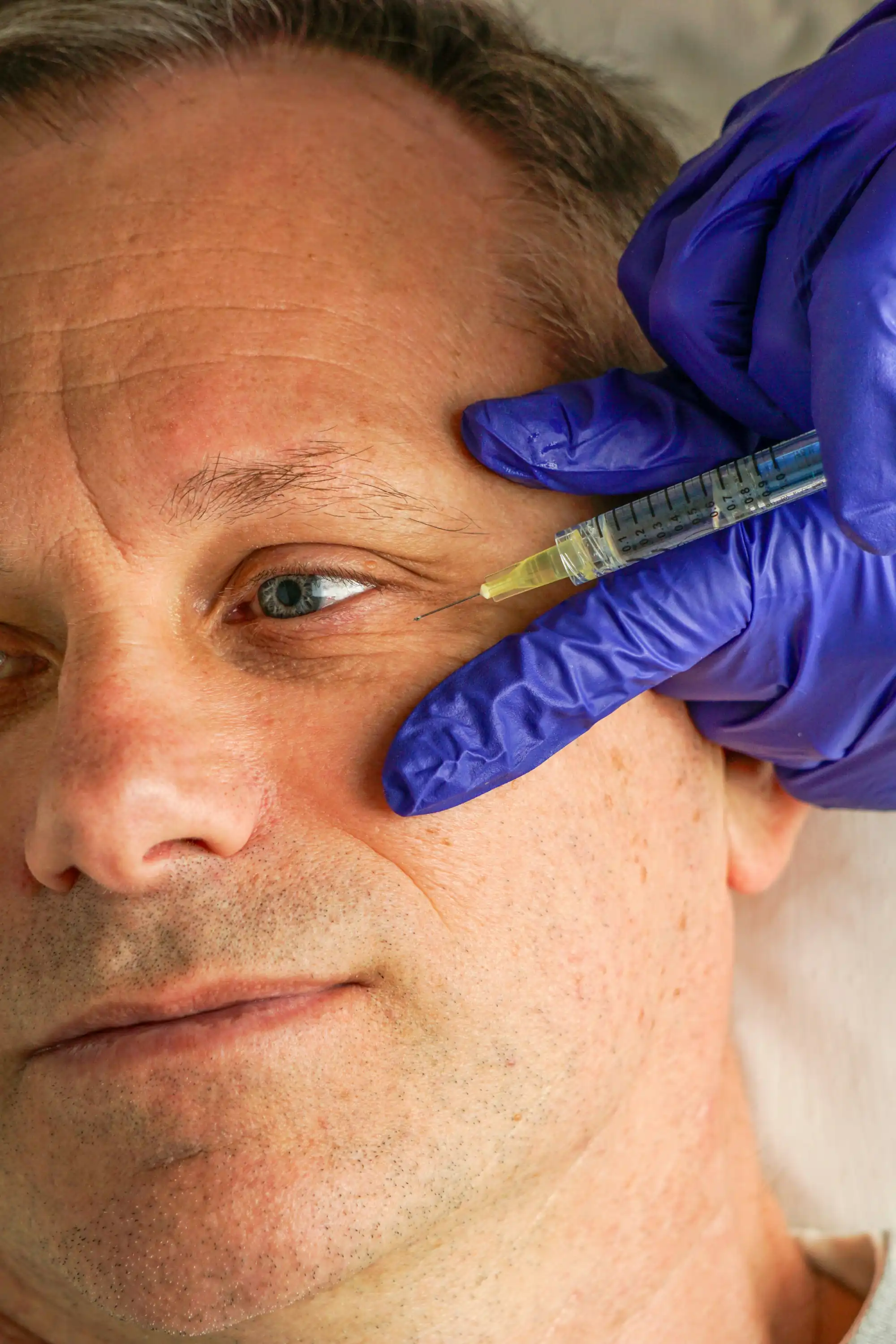 Augenbrauenlifting Prof. Dr. Christian Weinand World of Aesthetic Hamburg